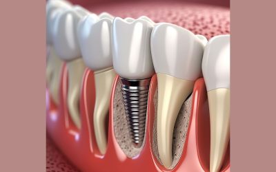 Impianti dentali nel trattamento dell’edentulia: opzioni e benefici